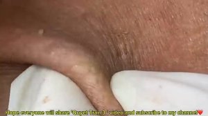 ВЫДАВЛИВАЕТ ПРЫЩИ И УГРИ. СОЧНОЕ РЕЛАКС ВИДЕО