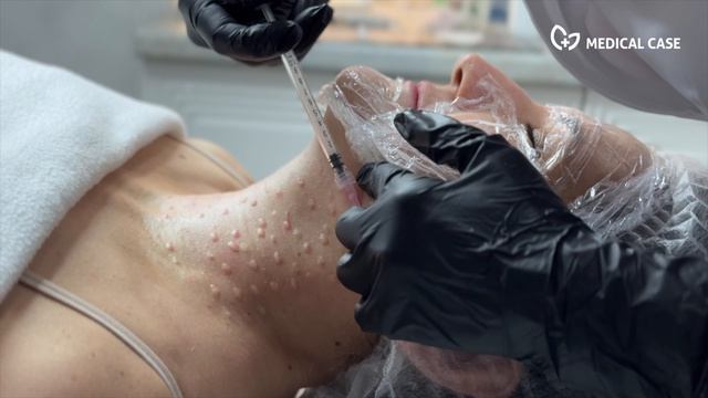 Процедура плазмотерапия смотреть онлайн