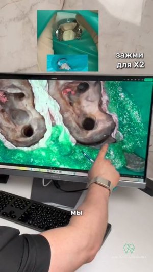 Хоти зубы разрушились под не герметичными коронками