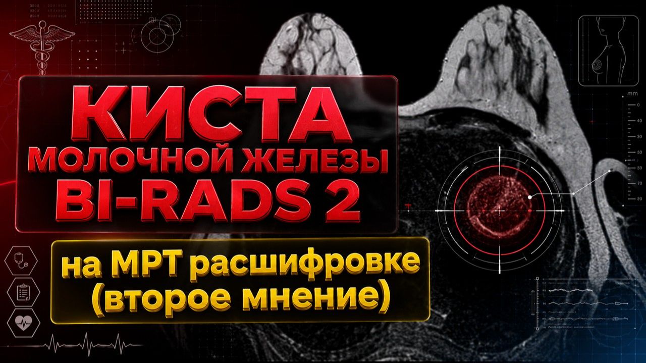 КИСТА молочной железы BI-RADS 2 БОЛЯТ молочные железы, аксиллярная ЛИМФАДЕНОПАТИЯ на РАСШИФРОВКЕ МРТ