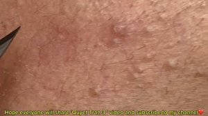 ВЫДАВЛИВАЕТ ПРЫЩИ И УГРИ. СОЧНОЕ РЕЛАКС ВИДЕО