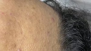 Удаление прыщей, комедонов, черных точек — видео