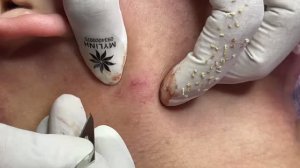 Удаление прыщей — полная чистка лица