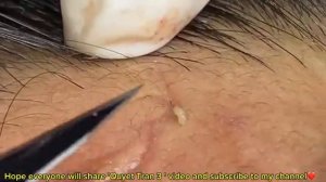 ВЫДАВЛИВАЕТ ПРЫЩИ И УГРИ. СОЧНОЕ РЕЛАКС ВИДЕО