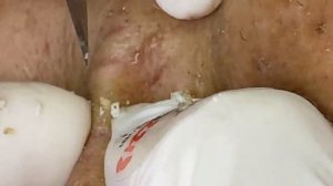 ВЫДАВЛИВАНИЕ ПРЫЩЕЙ И ОЧИЩЕНИЕ КОЖЫ ОТ ЧЕРНЫХ ТОЧЕК (33)