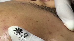 Механическая чистка лица от прыщей и черных точек