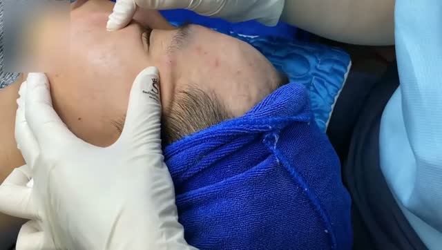 Удаление подкожных прыщей на щеках и скулах смотреть онлайн