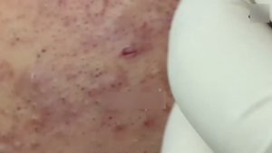 Экстракция черных точек — полная версия. Окончание