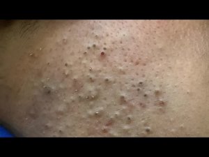 Глубокое очищение пор | Удаление черных точек с лица | Корейский уход за кожей