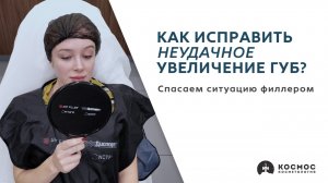 Как исправить неудачное увеличение губ? 👄 Спасаем ситуацию!