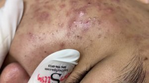213 • Acne collection • АСМР • Relax Spa