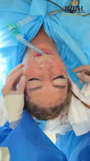 Подтяжка лица.Результат смотреть онлайн