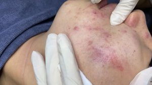 214 • Acne collection • АСМР • Relax Spa