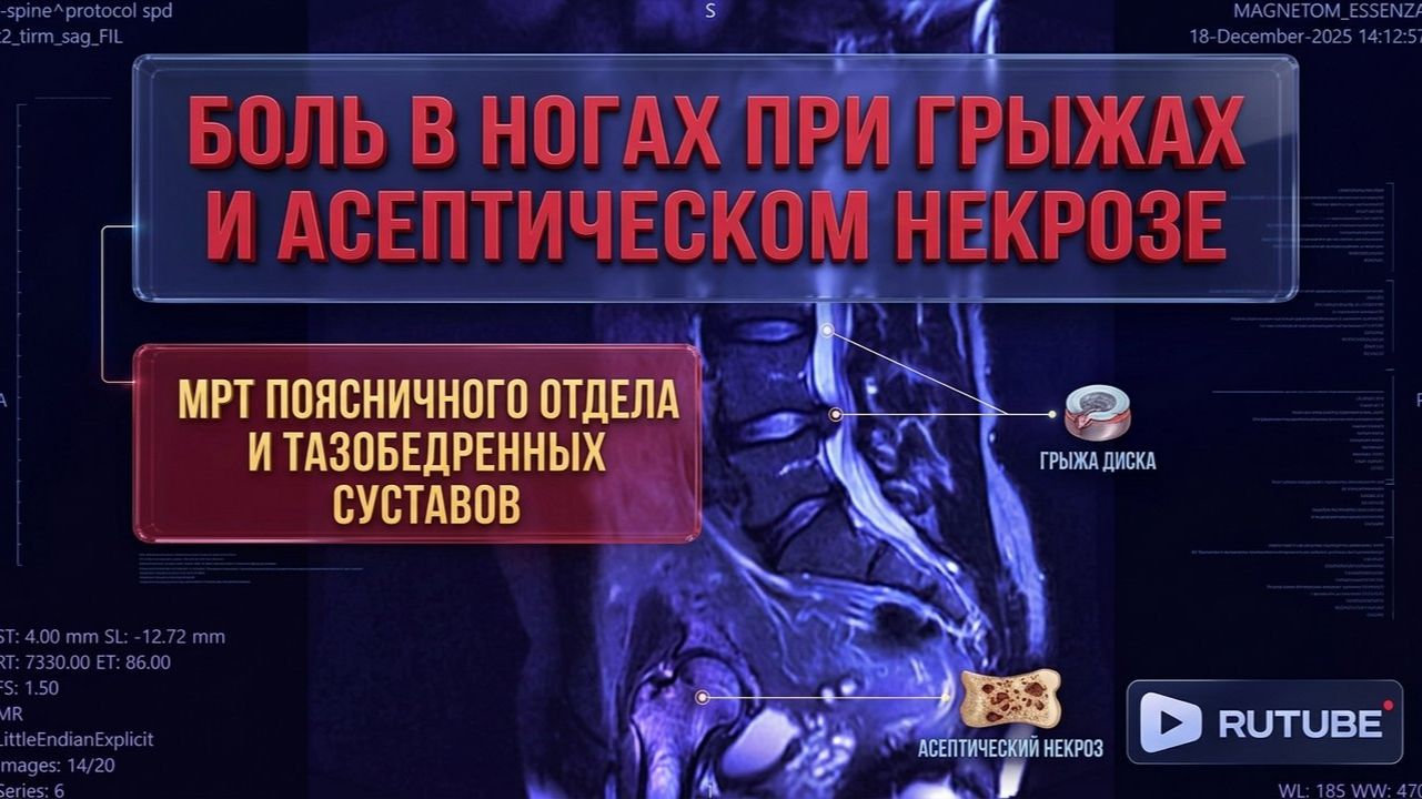 БОЛИ в ноге, АСЕПТИЧЕСКИЙ НЕКРОЗ головки бедренной кости, ГРЫЖИ L5 S1 на МРТ РАСШИФРОВКЕ поясницы смотреть онлайн