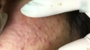 Удаление скрытых подкожных прыщей: опасно и непредсказуемо