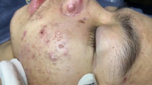 211 • Acne collection • АСМР • Relax Spa