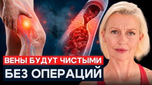 ЛЕЧЕНИЕ ВАРИКОЗА БЕЗ ОПЕРАЦИИ — Как Остановить Его Развитие И Сохранить Вены Здоровыми После 50