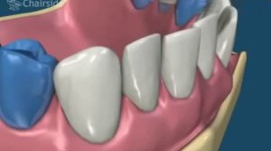 Breket-3D