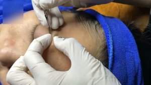 Удаление прыщей на лбу — чистим Т-зону