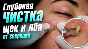 Очищение от воспаленных комедонов и экстракция глубоких кист с заботливым подходом