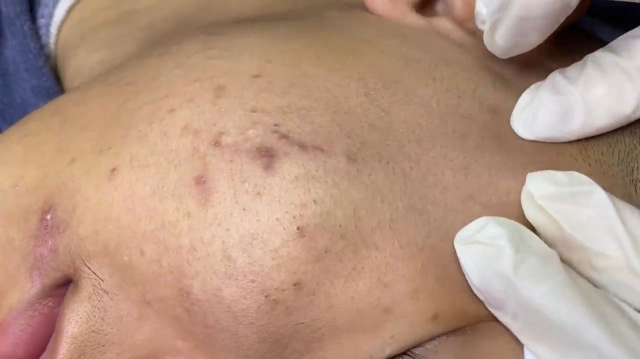 215 • Acne collection • АСМР • Relax Spa смотреть онлайн