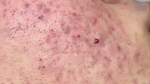 Экстракция черных точек — полная версия. Продолжение