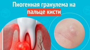 🤚 Пиогенная гранулема на пальце кисти. Клинический случай № 1805