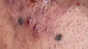 Выдавливание прыщей и удаление черных точек (17)
