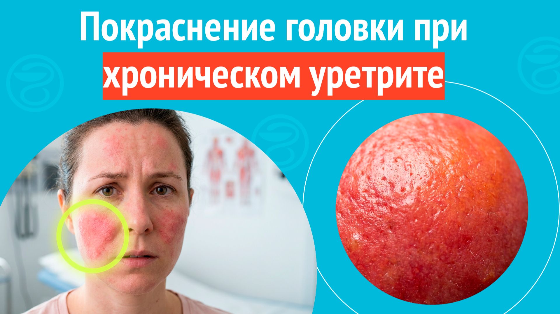 😡 Покраснение головки при хроническом уретрите. Клинический случай № 1733 смотреть онлайн