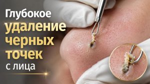 Нежное удаление акне с интенсивным очищением глубоких кист