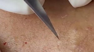 ДЛИННОЕ ВИДЕО ВЫДАВЛИВАНИЕ ПРЫЩЕЙ БОЛЬШЕ ЧАСА ДОЛГОЕ (17)