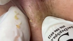 ДЛИННОЕ ВИДЕО ВЫДАВЛИВАНИЕ ПРЫЩЕЙ БОЛЬШЕ ЧАСА ДОЛГОЕ (23)