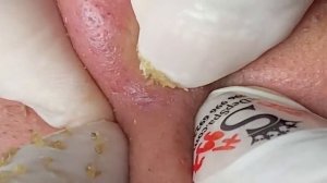 Выдавливание прыщей и удаление черных точек (18)