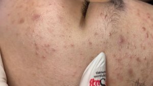 220 • Acne collection • АСМР • Relax Spa