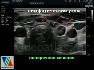 Паратрахеальные лимфоузлы