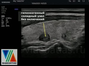 Разные типы узлов ЩЖ (еще примеры)