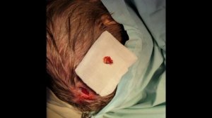 Удаление новообразования на волосистой части головы