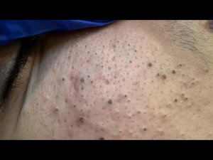 Глубокое очищение пор | Удаление черных точек, лечение прыщей и уход за лицом