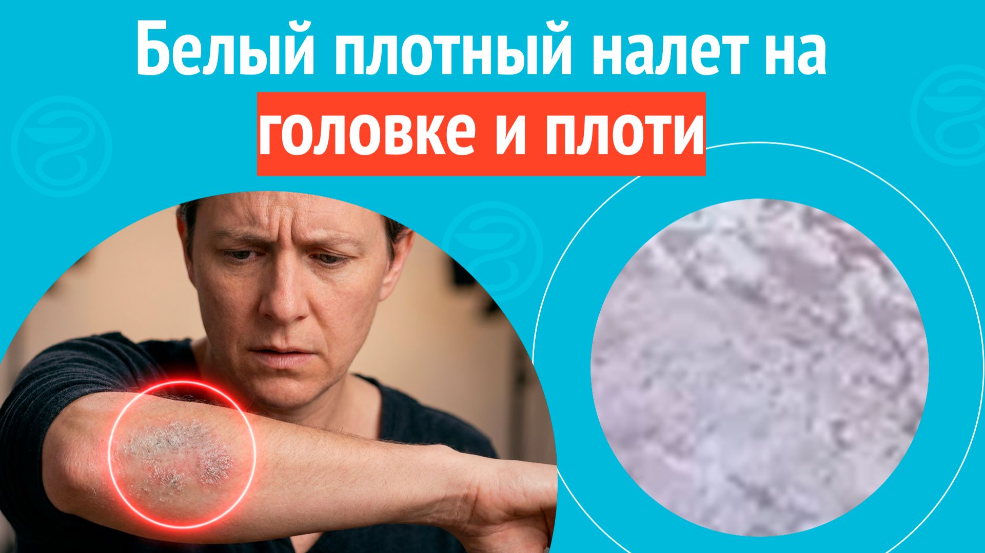 😕 Белый плотный налет на головке и плоти. Клинический случай № 1736 смотреть онлайн