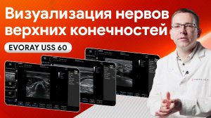 Как EVORAY USS 60 показывает периферические нервы верхней конечности?