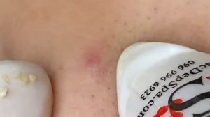 Выдавливание прыщей и удаление черных точек (20)