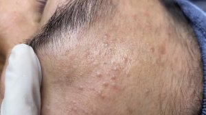216 • Acne collection • АСМР • Relax Spa
