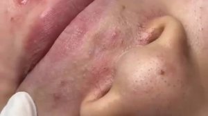 ДЛИННОЕ ВИДЕО ВЫДАВЛИВАНИЕ ПРЫЩЕЙ БОЛЬШЕ ЧАСА ДОЛГОЕ (21)