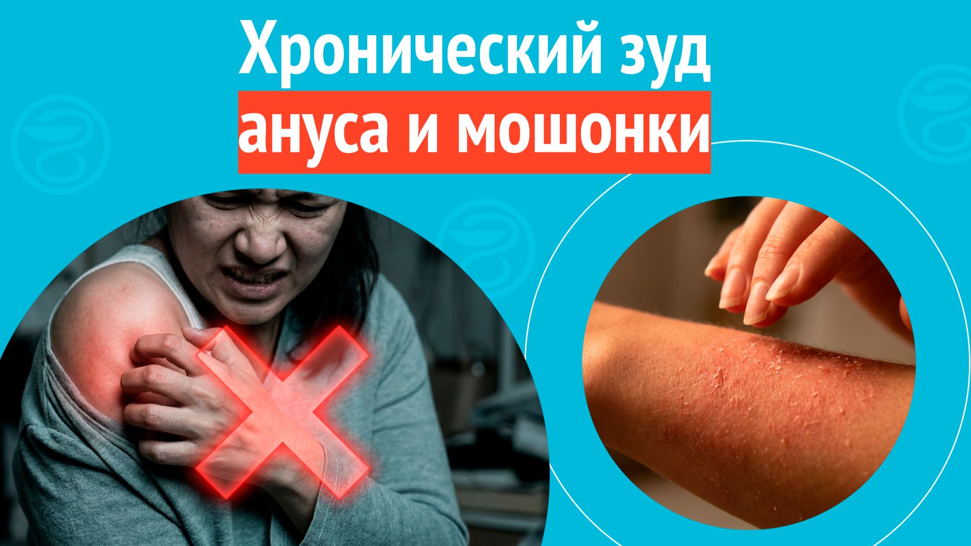 ➡️ Хронический зуд ануса и мошонки. Клинический случай № 1731 смотреть онлайн
