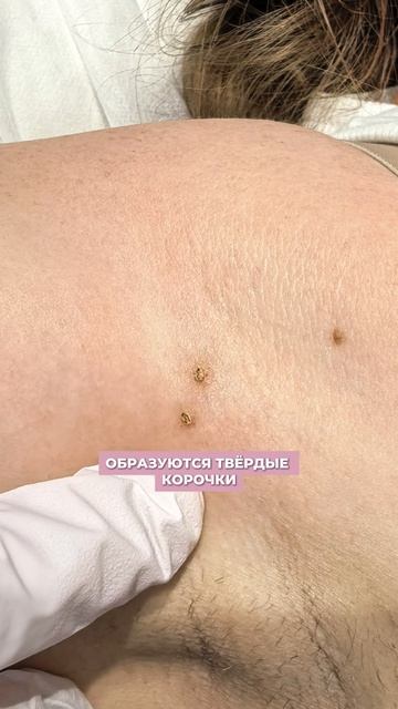 Удаление папиллом под мышкой: до и после процедуры