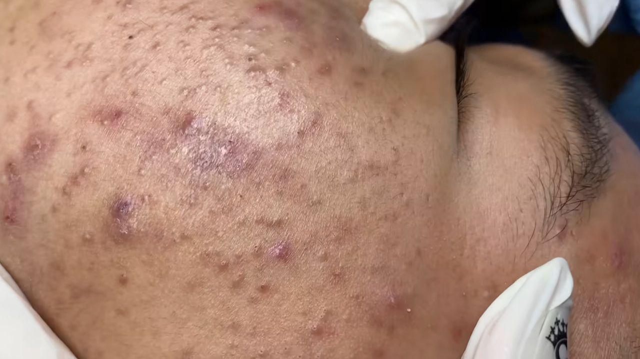 223 • Acne collection • АСМР • Relax Spa смотреть онлайн