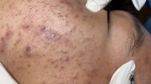 223 • Acne collection • АСМР • Relax Spa