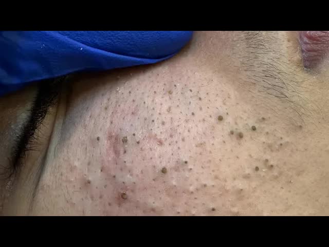 Глубокое удаление черных точек | Корейский уход за кожей для чистых пор смотреть онлайн
