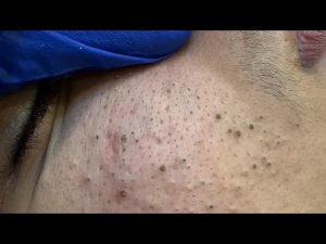 Глубокое удаление черных точек | Корейский уход за кожей для чистых пор