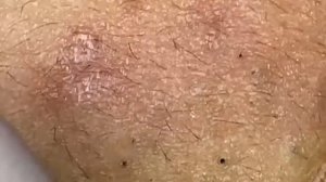 Спокойное удаление прыщей для релакса